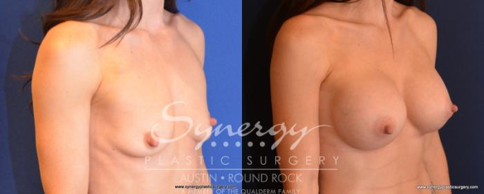 Before & After Breast Augmentation Case 529 View #2 View in Austin, TX