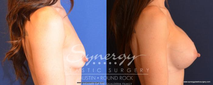 Before & After Breast Augmentation Case 529 View #3 View in Austin, TX