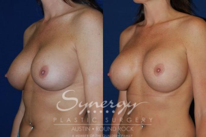 Before & After Breast Augmentation Case 53 View #2 View in Austin, TX
