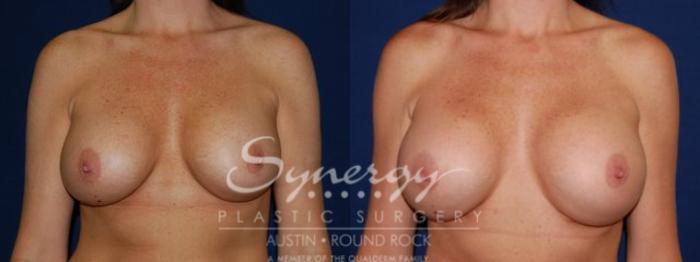 Before & After Breast Augmentation Case 53 View #3 View in Austin, TX