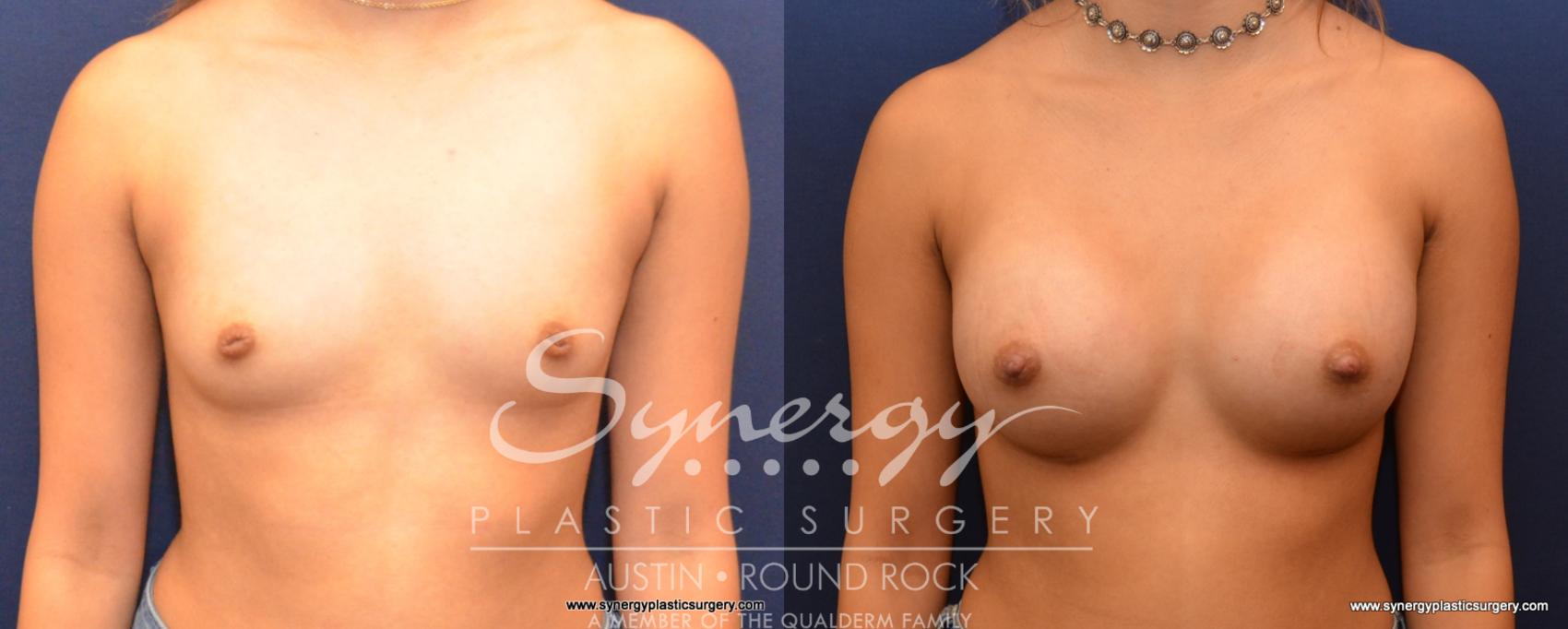 Before & After Breast Augmentation Case 531 View #1 View in Austin, TX