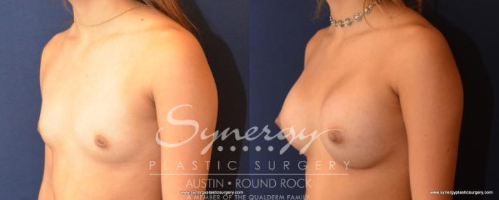 Before & After Breast Augmentation Case 531 View #2 View in Austin, TX
