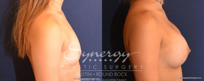 Before & After Breast Augmentation Case 531 View #5 View in Austin, TX