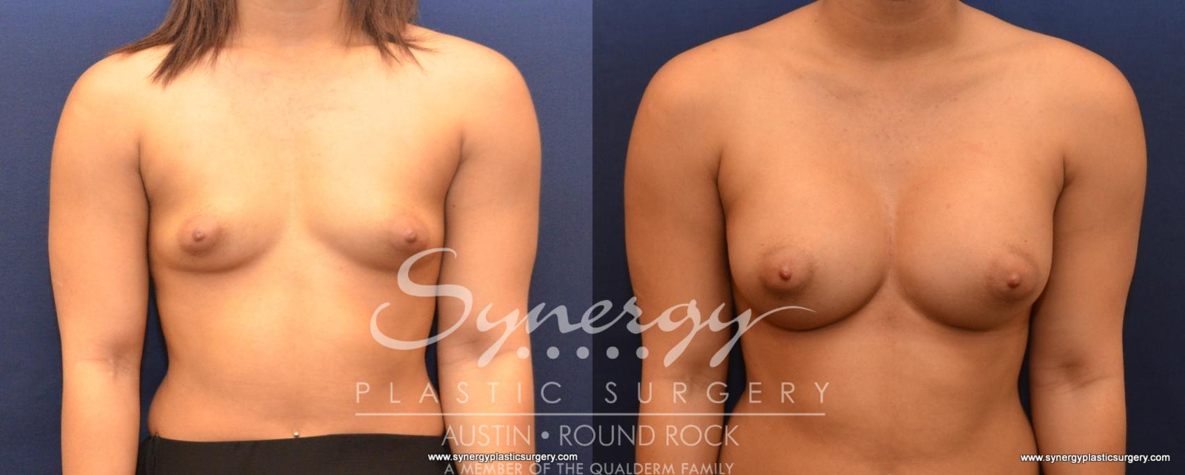 Before & After Breast Augmentation Case 532 View #1 View in Austin, TX