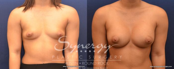 Before & After Breast Augmentation Case 532 View #1 View in Austin, TX