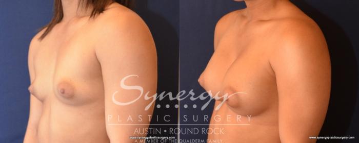Before & After Breast Augmentation Case 532 View #2 View in Austin, TX
