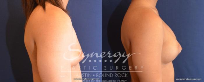 Before & After Breast Augmentation Case 532 View #3 View in Austin, TX