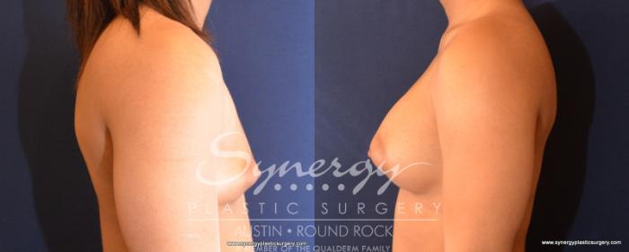 Before & After Breast Augmentation Case 532 View #4 View in Austin, TX