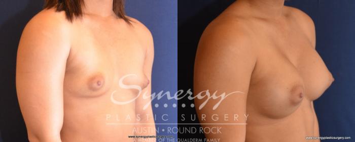 Before & After Breast Augmentation Case 532 View #5 View in Austin, TX