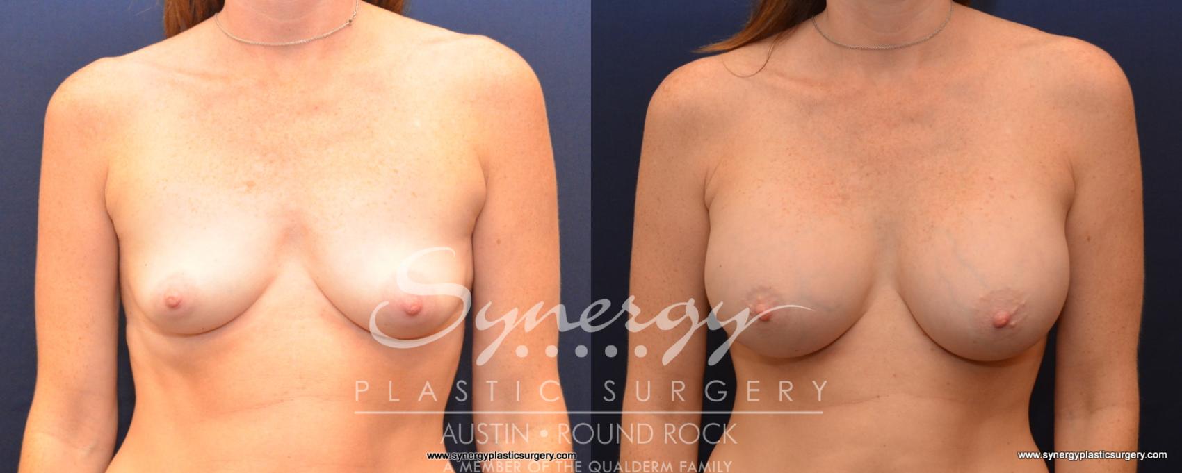 Before & After Breast Augmentation Case 534 View #1 View in Austin, TX
