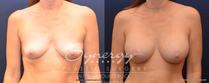 Before & After Breast Augmentation Case 534 View #1 View in Austin, TX