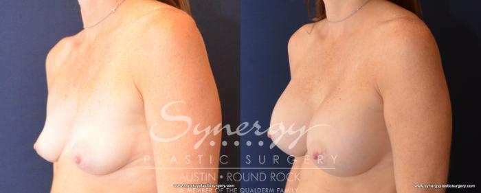 Before & After Breast Augmentation Case 534 View #2 View in Austin, TX