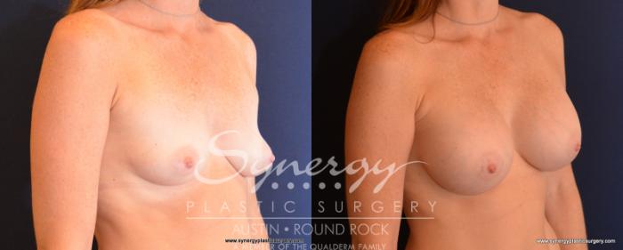 Before & After Breast Augmentation Case 534 View #4 View in Austin, TX