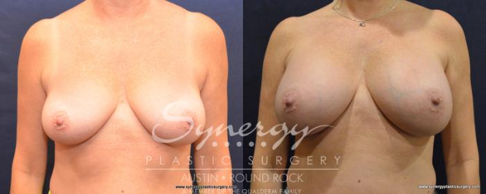 Before & After Breast Augmentation Case 535 View #1 View in Austin, TX