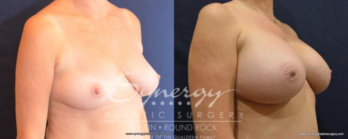 Before & After Breast Augmentation Case 535 View #2 View in Austin, TX