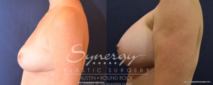 Before & After Breast Augmentation Case 535 View #3 View in Austin, TX
