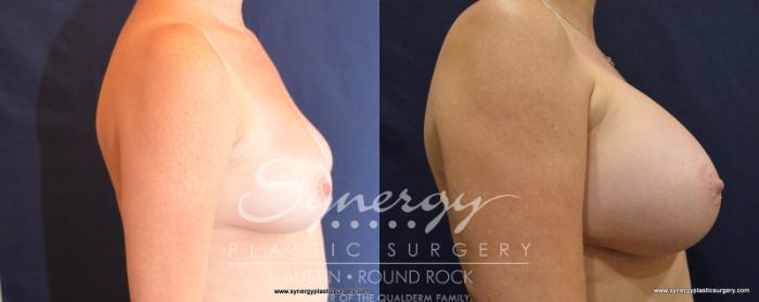 Before & After Breast Augmentation Case 535 View #4 View in Austin, TX