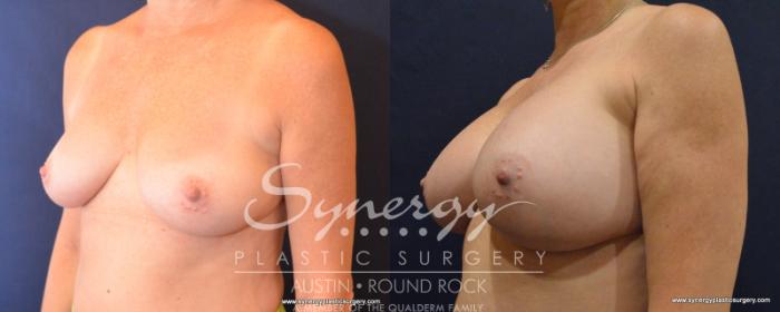 Before & After Breast Augmentation Case 535 View #5 View in Austin, TX