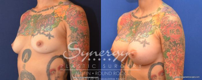 Before & After Breast Augmentation Case 539 View #2 View in Austin, TX
