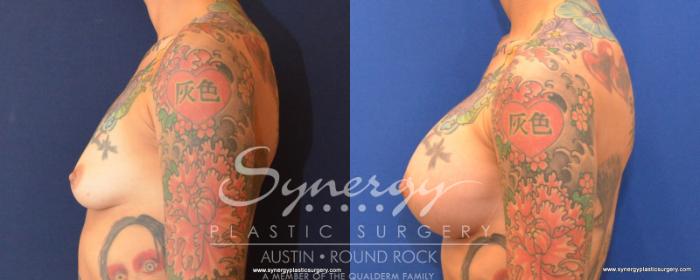 Before & After Breast Augmentation Case 539 View #3 View in Austin, TX