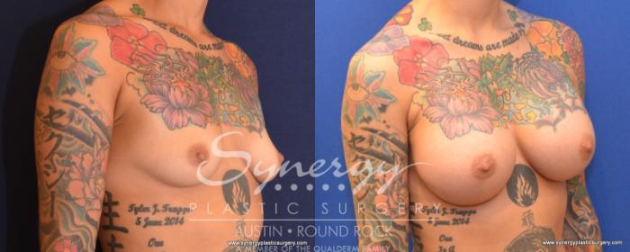 Before & After Breast Augmentation Case 539 View #4 View in Austin, TX