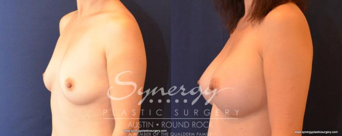 Before & After Breast Augmentation Case 544 View #2 View in Austin, TX