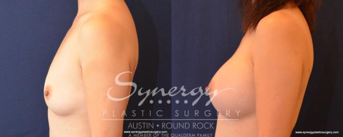 Before & After Breast Augmentation Case 544 View #3 View in Austin, TX
