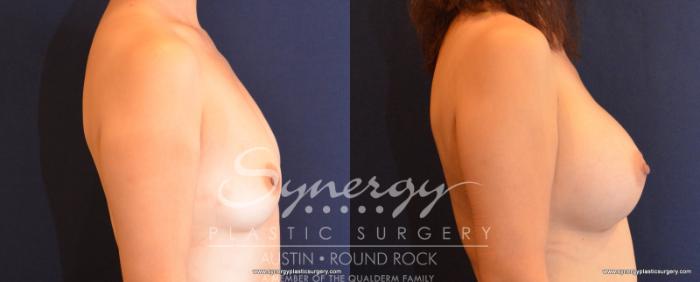 Before & After Breast Augmentation Case 544 View #4 View in Austin, TX