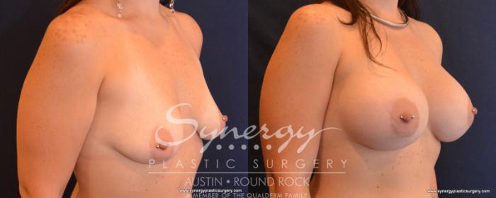 Before & After Breast Augmentation Case 545 View #2 View in Austin, TX