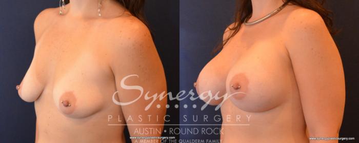 Before & After Breast Augmentation Case 545 View #3 View in Austin, TX