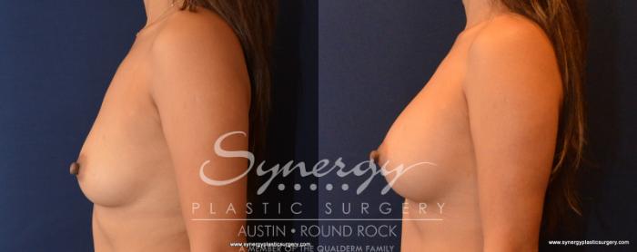 Before & After Breast Augmentation Case 546 View #3 View in Austin, TX