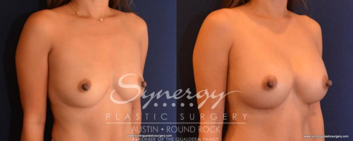 Before & After Breast Augmentation Case 546 View #4 View in Austin, TX