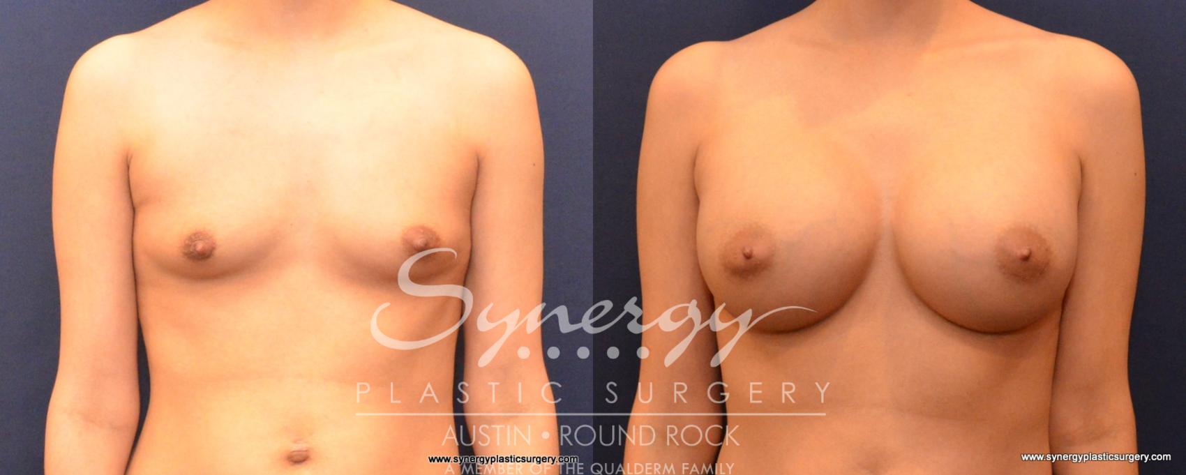 Before & After Breast Augmentation Case 549 View #1 View in Austin, TX