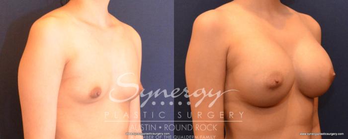 Before & After Breast Augmentation Case 549 View #3 View in Austin, TX
