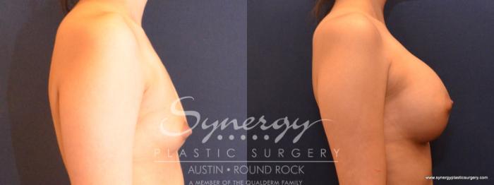 Before & After Breast Augmentation Case 549 View #4 View in Austin, TX