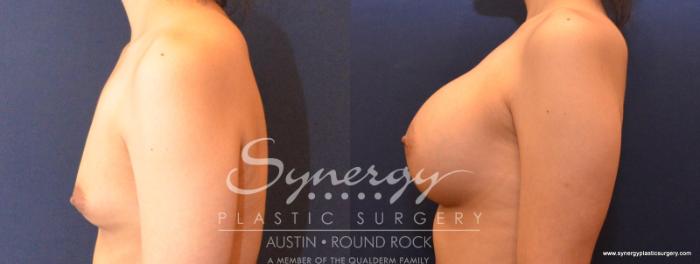 Before & After Breast Augmentation Case 549 View #5 View in Austin, TX