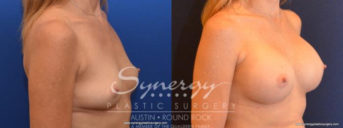 Before & After Breast Augmentation Case 552 View #2 View in Austin, TX