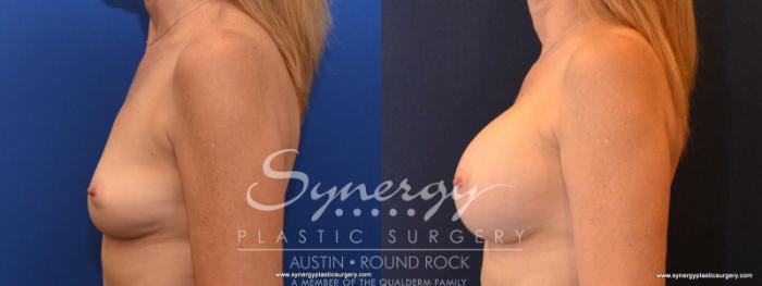 Before & After Breast Augmentation Case 552 View #3 View in Austin, TX