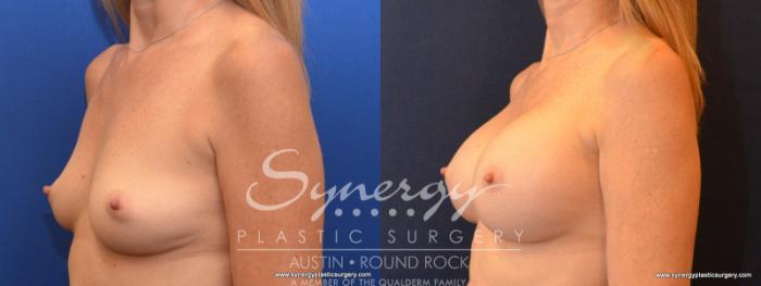Before & After Breast Augmentation Case 552 View #4 View in Austin, TX