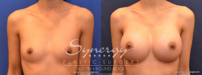 Before & After Breast Augmentation Case 553 View #1 View in Austin, TX