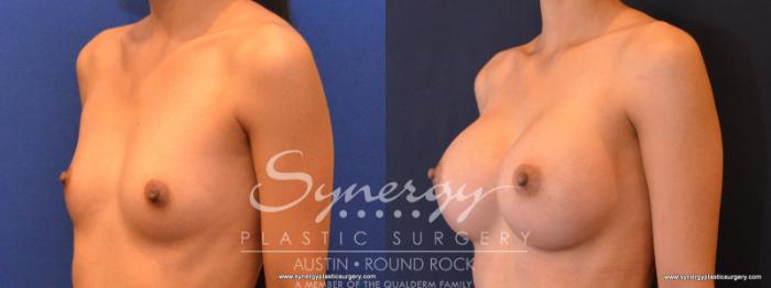 Before & After Breast Augmentation Case 553 View #2 View in Austin, TX