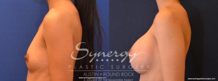 Before & After Breast Augmentation Case 553 View #3 View in Austin, TX