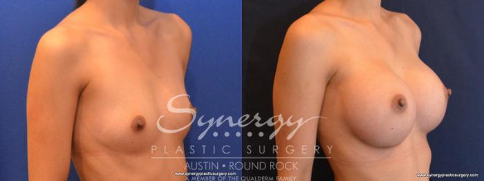 Before & After Breast Augmentation Case 553 View #4 View in Austin, TX