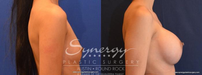 Before & After Breast Augmentation Case 553 View #5 View in Austin, TX