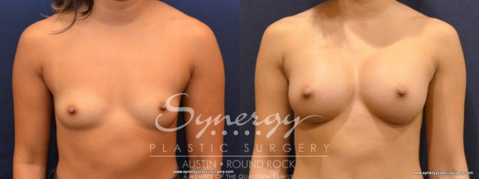Before & After Breast Augmentation Case 554 View #1 View in Austin, TX