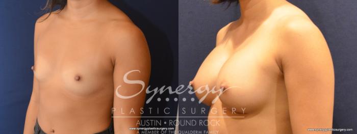 Before & After Breast Augmentation Case 554 View #2 View in Austin, TX
