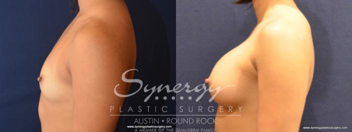 Before & After Breast Augmentation Case 554 View #3 View in Austin, TX