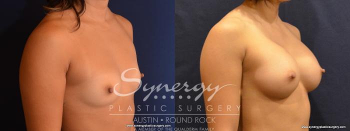 Before & After Breast Augmentation Case 554 View #4 View in Austin, TX