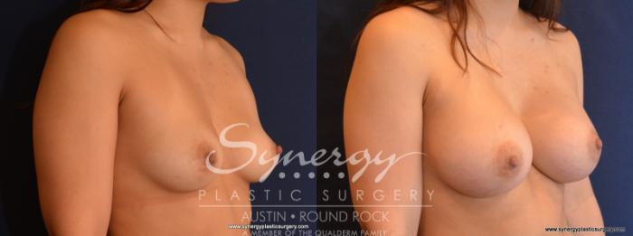 Before & After Breast Augmentation Case 557 View #2 View in Austin, TX