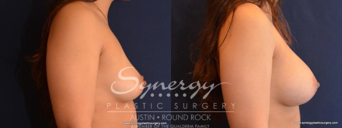 Before & After Breast Augmentation Case 557 View #3 View in Austin, TX